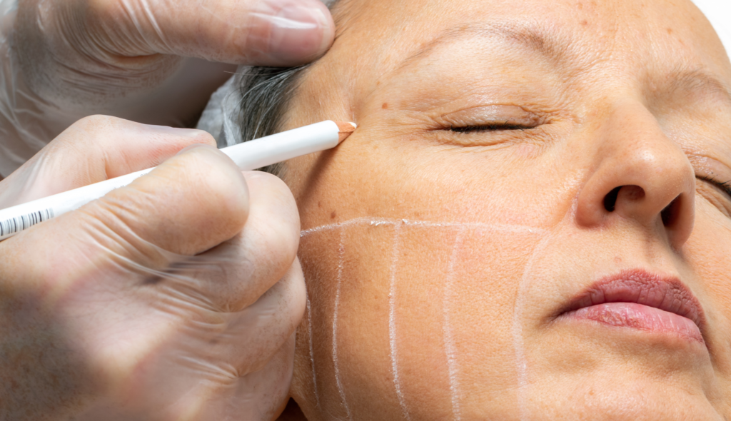 HIFU Lifting non chirurgical, rajeunissement de la peau